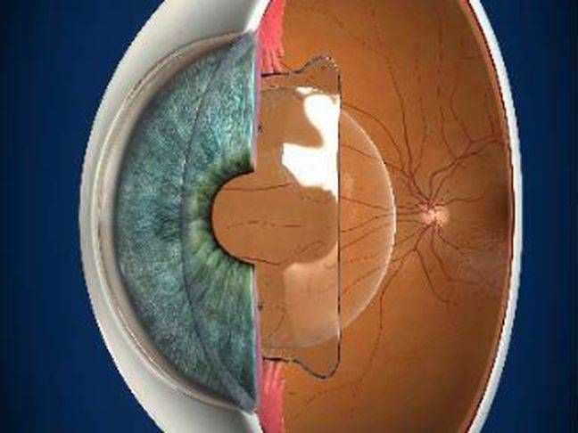 Miopia elevata, nuove tecniche con laser a femtosecondi e lenti fachiche Icl laser femtosecondi miopia
