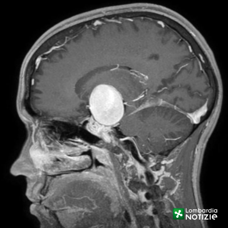 Aneurisma gigante nel cervello, giovane veneta salvata al Niguarda aneurisma gigante niguarda